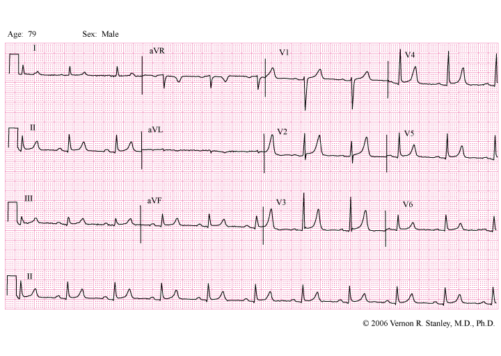 Ecg Tracing Interpretation