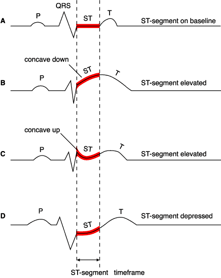 Non St Segment Elevation Meaning