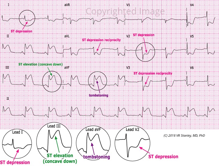 Acute Inferior STEMI Dr. Stanley's Dr. Stanley's