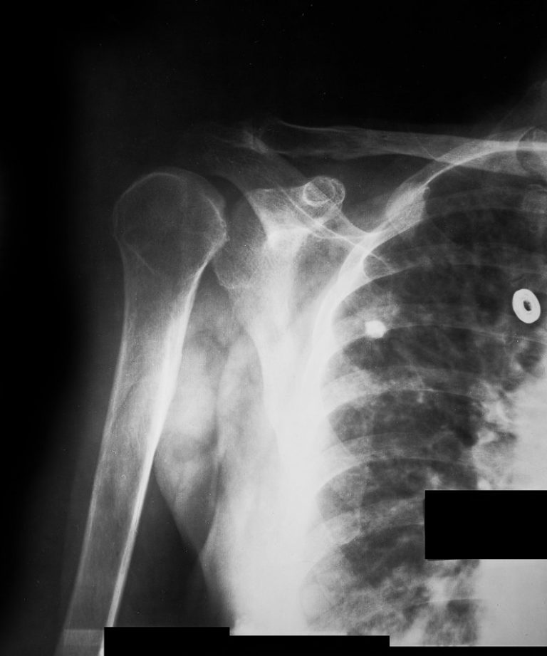 Shoulder XRay..... Normal Copy Dr. Stanley's Dr
