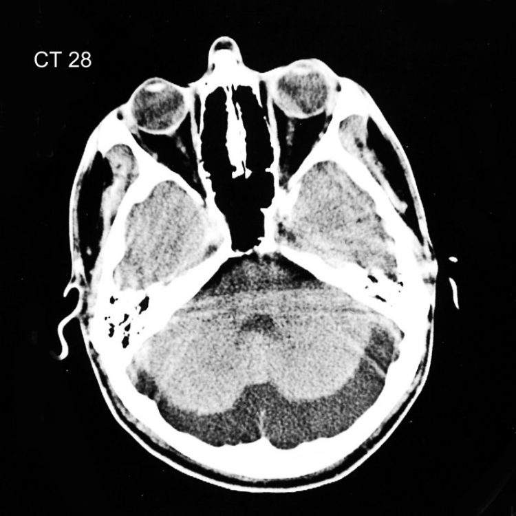 What Is Prominent Cisterna Magna