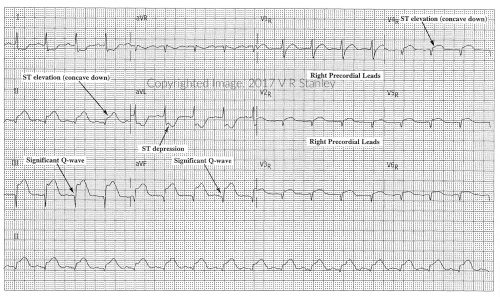 Acute RV STEMI Edited - ECGcourse.com