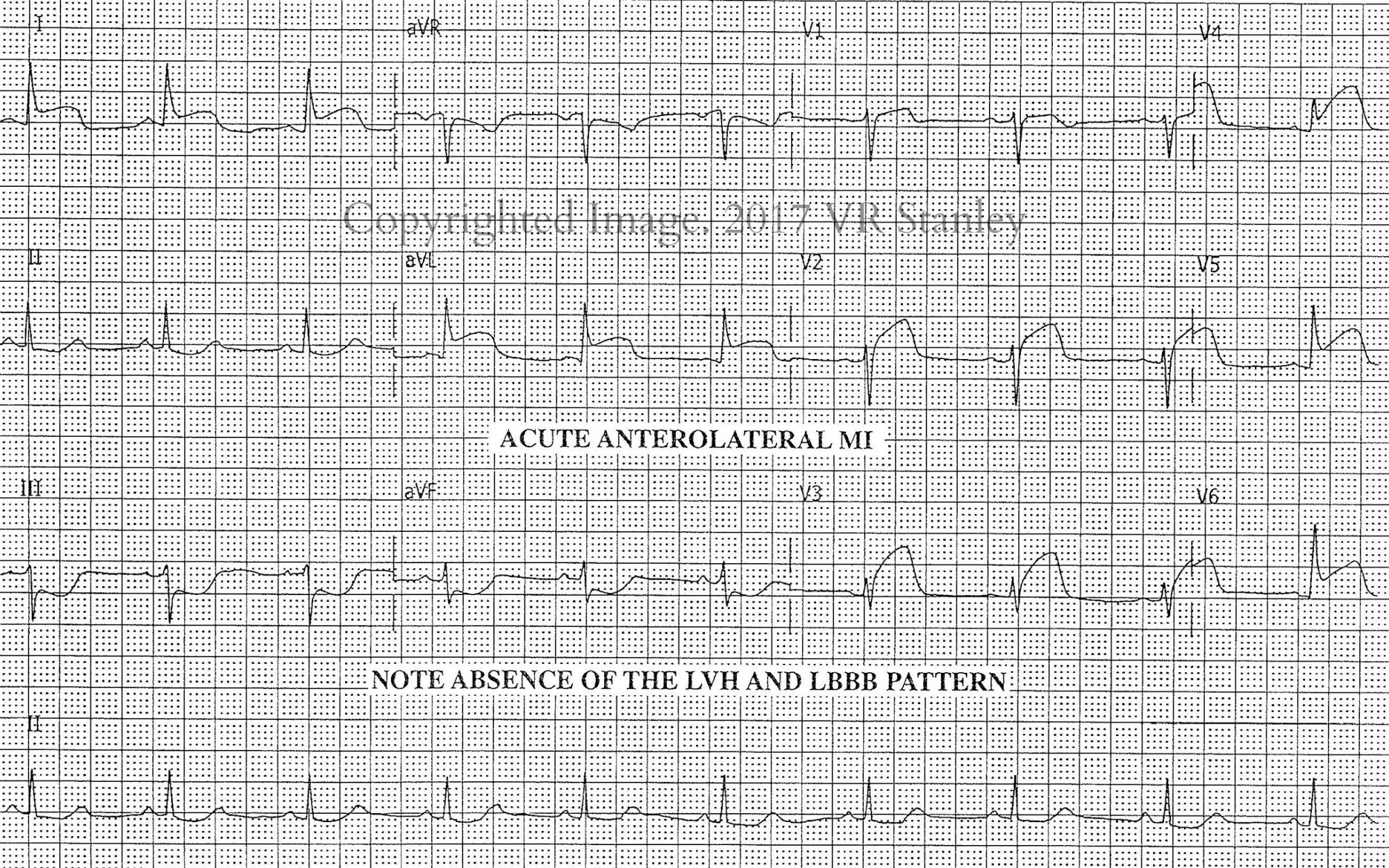 Dsae Stemi Review Part 1 Classic Anterolateral Highlateral Stemi ...