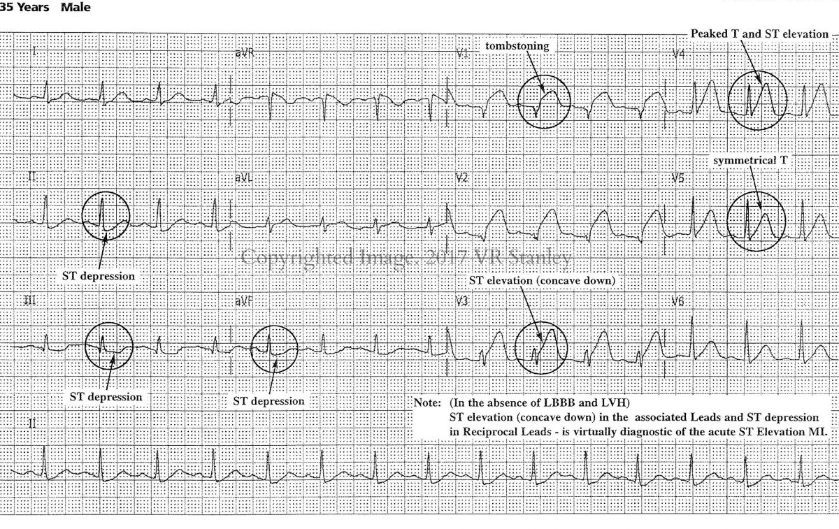 DSAE STEMI REVIEW, Part 1: Classic Anterior STEMI Pattern - ECGcourse.com