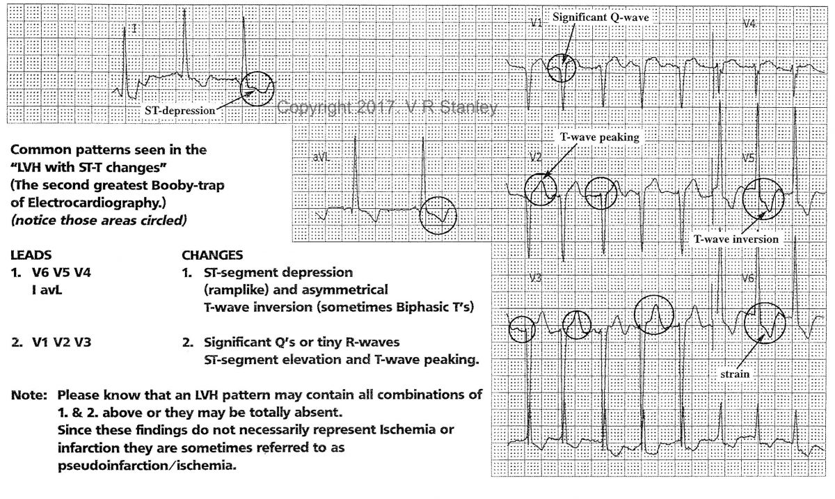 LVH (Left Ventricular Hypertrophy) as a STEMI Mimic ECGcourse.com