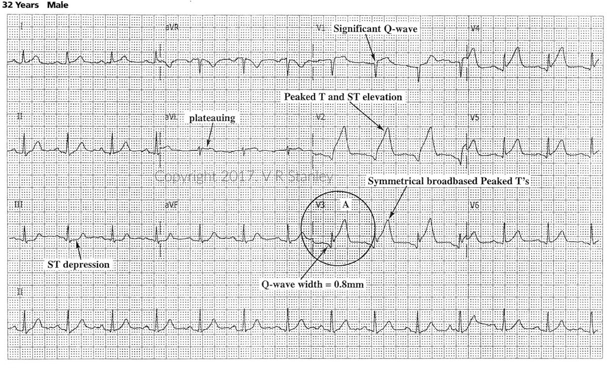 example ecg tracing of ivcd