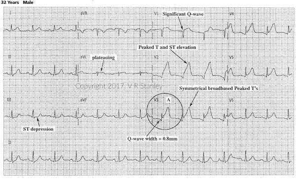 Part I: Differential Diagnosis for Peaking T-waves on the 12-lead ECG ...