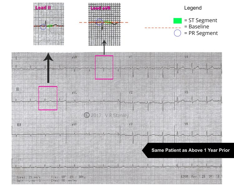Pericarditis patient from 1 year ago Dr Stanleys ECG Courses