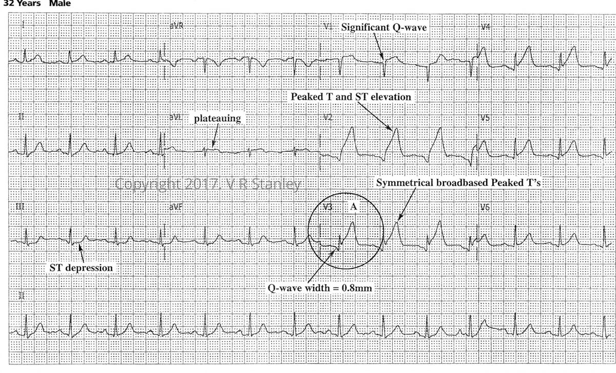 2 Cases ST Elevation: Benign Normal Variant vs Acute STEMI - Dr ...