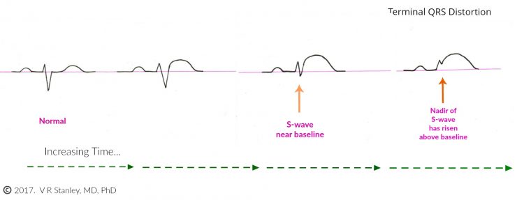 Terminal QRS Distortion Diagram Dr Stanleys ECG Courses