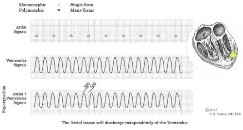 Wide Complex Tachycardia: V Tach or Wide-complex SVT - ECGcourse.com