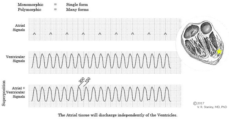 V tach shop vs supraventricular tachycardia