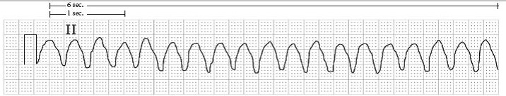 Ventricular Tachycardia ECG Rhythm Sample