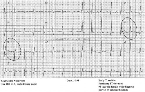 Ventricular Aneurysm ECG 1 - ECGcourse.com