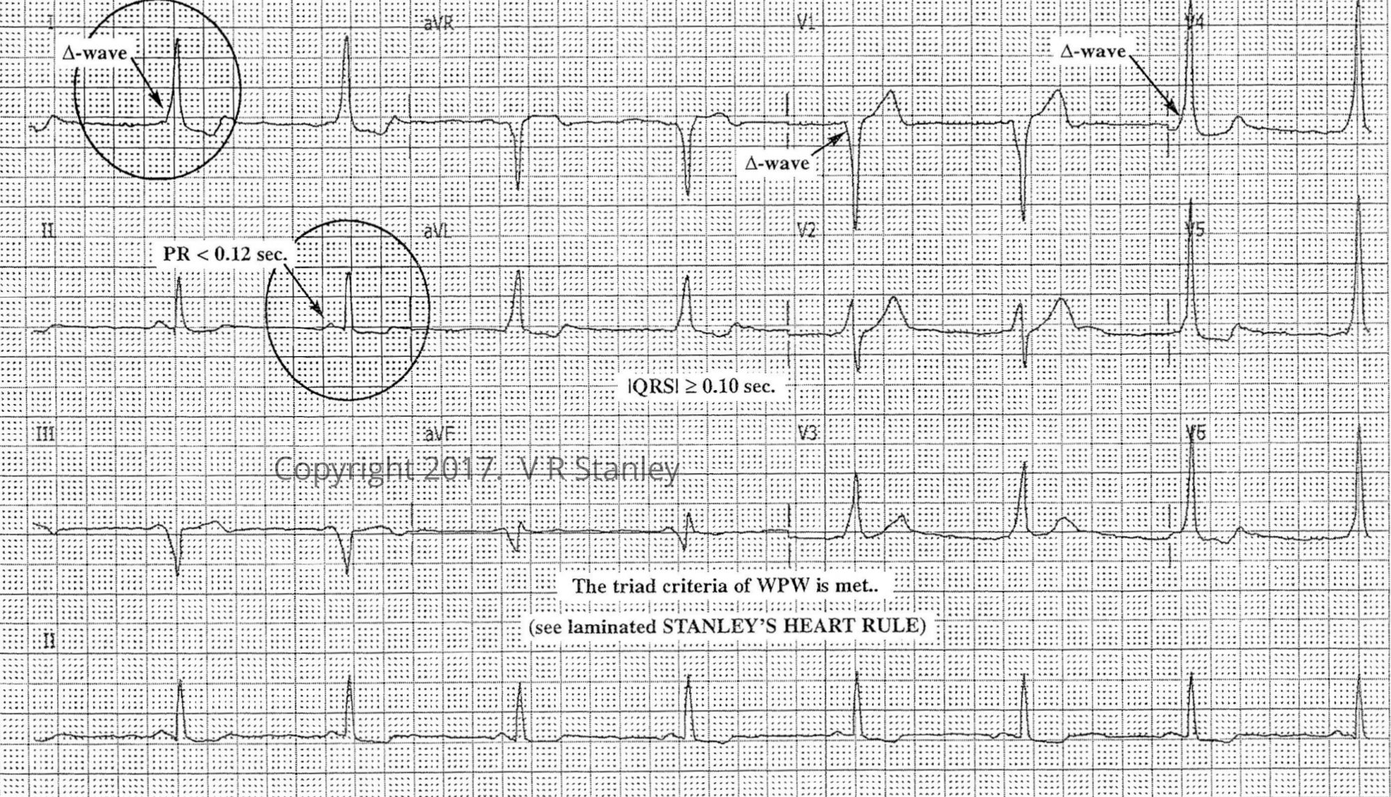 Wpw экг признаки. STEMI на ЭКГ. Критерии STEMI на ЭКГ. Wpw картинки ЭКГ. Wpw синдром.