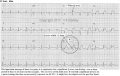 Terminal QRS Distortion on the 12-lead ECG - ECGcourse.com