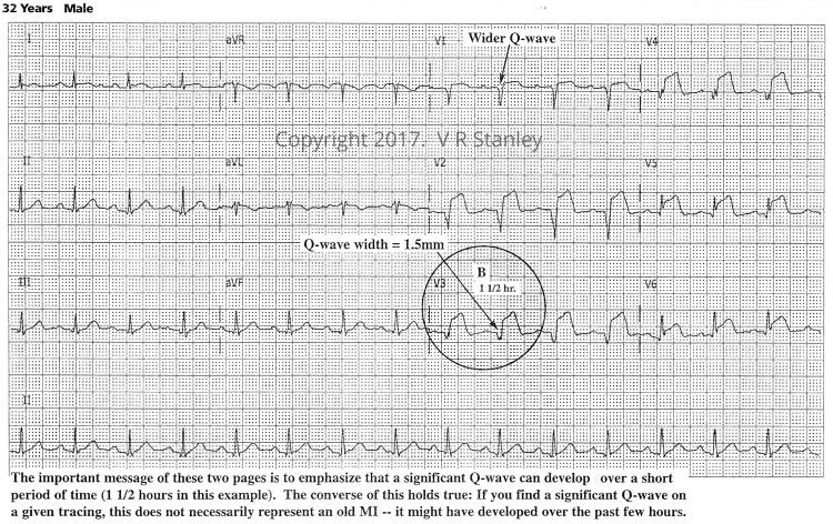Evolving terminal QRS distortion on 12-lead ECG Stanley's ECG courses