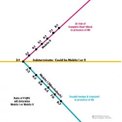 ECG Rhythms: Is this Rhythm Second Degree AV Block 2:1 Mobitz 1 (I) or ...