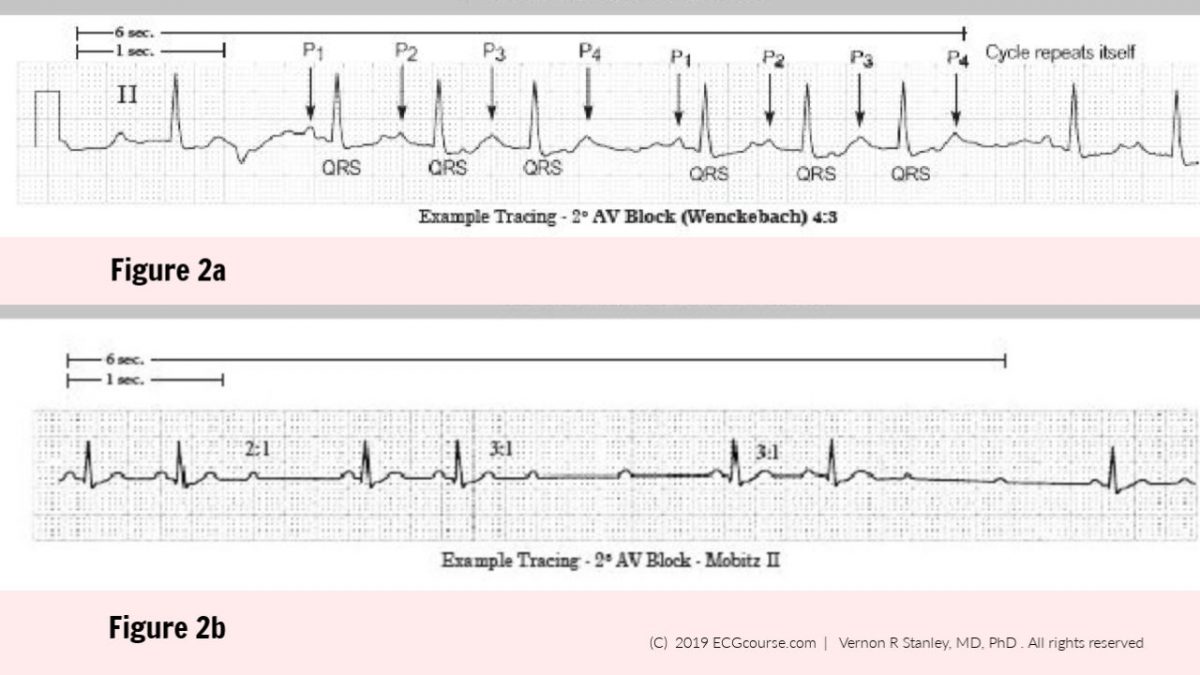 Rhythms Review: Is this Second Degree AV Block 2:1 Mobitz I or Mobitz ...