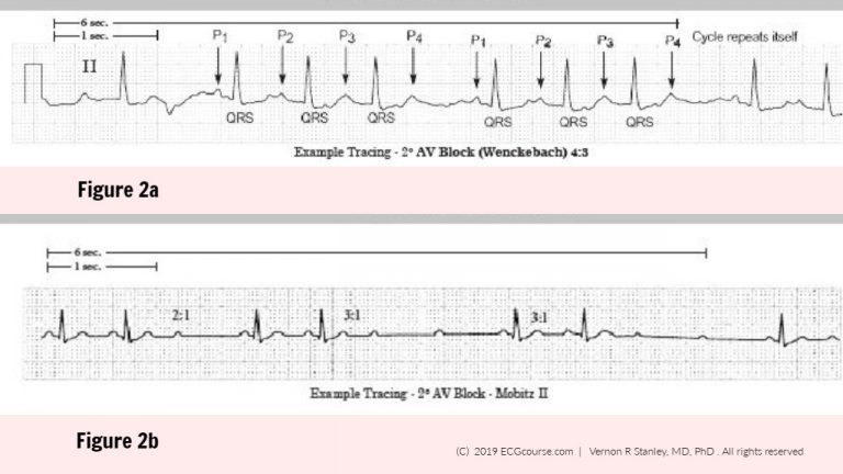 ECG Rhythms: Is this Rhythm Second Degree AV Block 2:1 Mobitz 1 (I) or ...