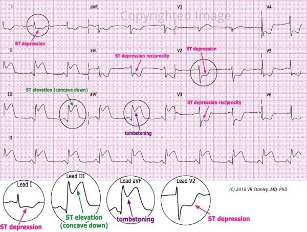 Acute Inferior STEMI - ECGcourse.com