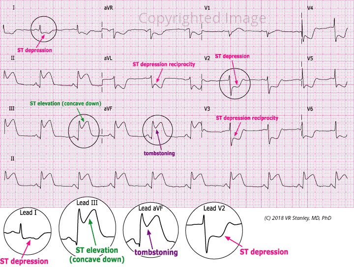 Inferior STEMI. There is > 1mm of ST elevation in leads II, III and