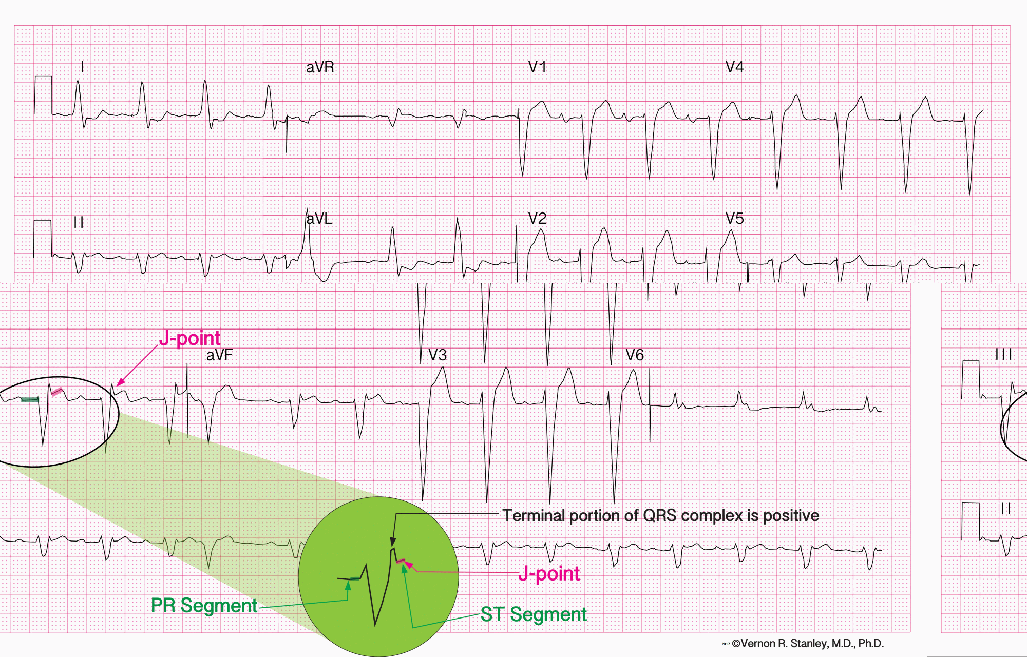 Sgarbossa-B-GIF-File - ECGcourse.com