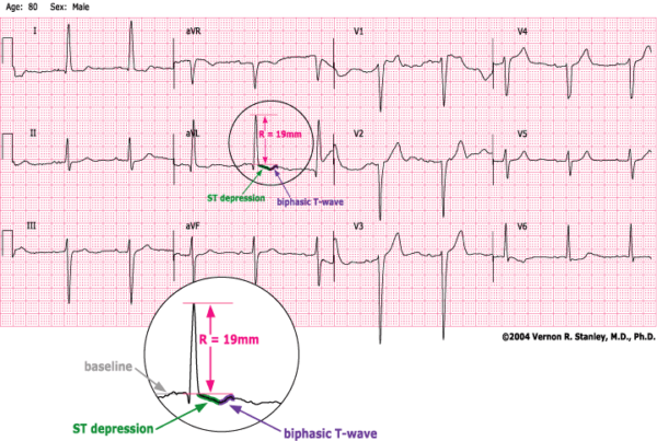 LVH (Left Ventricular Hypertrophy) As A STEMI Mimic - ECGcourse.com