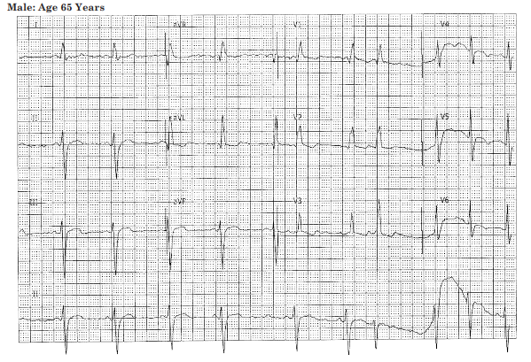 12-lead ECG Showing RBBB with Primary T-waves Stanleys ECG Course