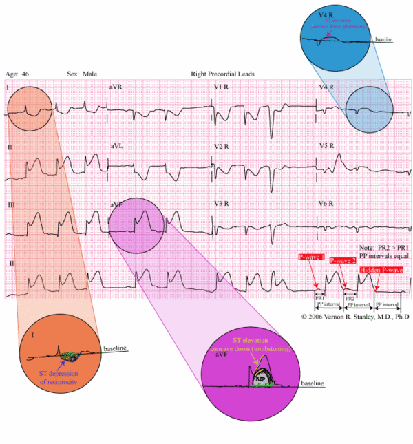 Acute Inferior MI - ECGcourse.com