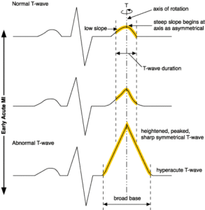 ECG Peaking Hyperacute T wave Diagram Acute STEMI