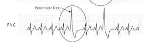 Morphology of a Premature Ventricular Contraction Dr Stanleys ECG Rhythm Courses