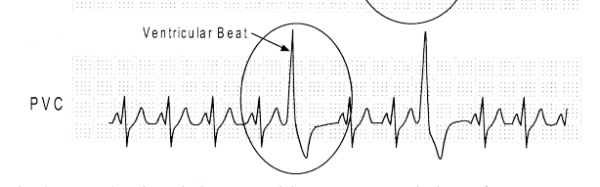 Morphology Of The Pac Pjc And Pvc On Ecg Rhythms Premature