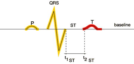 Normal T wave ECG Rhythm Stanley ECG Courses